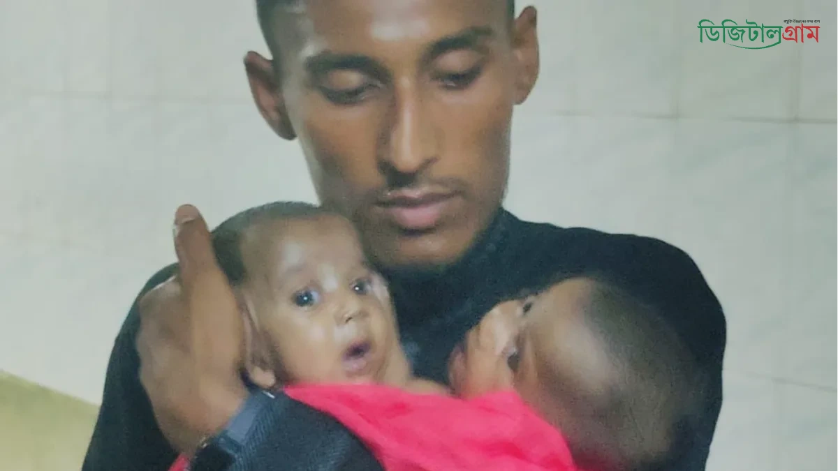 সরকারি খরচে ঢামেকে জোড়া লাগানো দুই শিশুর চিকিৎসা প্রধানমন্ত্রীর নির্দেশ